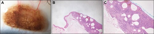 Figure 3 (A) Magnified slit-lamp image showing the pigmented lesion with numerous small cysts. (B) Histopathological slide of the tumor stained with H&E, ×20. (C) Histopathological slide of the tumor stained with H&E, ×50. Numerous nests of nevus cells containing abundant melanin pigment can be seen under the conjunctival epithelium.