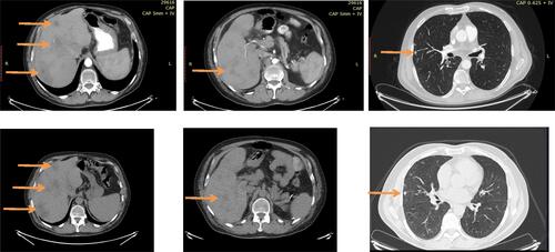 Figure 2 CT scans of patient 2. Upper line showing liver and lung lesions before therapy and lower line showing the same lesions after the administration of 6 cycles of Doxorubicin plus Olaratumab. Arrows highlight the lesions.