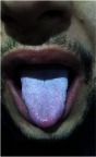 Figure 1 White coated tongue.