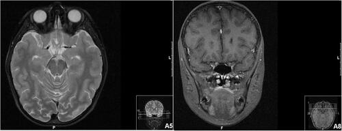 Figure 2 Brain and orbits magnetic resonance imaging (MIR) of patient 1. T2 hyperintensity in the posterior region of the left optic nerve and the optic chiasm.