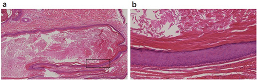 Figure 2 Epidermoid cyst lined by stratified squamous epithelium having granular layer and filled with laminated keratin material. (a) Bar length = 3mm. The rectangular box shows the structure of the cyst wall. (b) Bar length = 400μm.