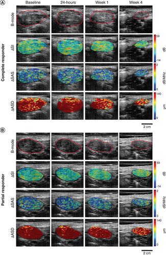 Figure 2. Quantitative ultrasound parametric maps.Representative QUS parametric image overlays of ΔSI, ΔSAS and ΔASD at baseline, 24 h, week 1 and 4 of treatment for a complete responder (A) and a partial responder (B). The ultrasound B-mode images have been contoured to delineate the lymph node that was scanned.ASD: Average scatterer diameter; QUS: Quantitative ultrasound; SAS: Spacing among scatterers; SI: Spectral intercept.