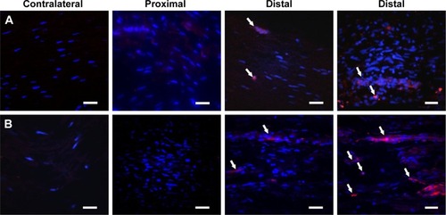 Figure 9 After 7 days posttransplant in the contralateral nerve and the proximal and distal areas of the ipsilateral sciatic nerve. (A) Detection of transplanted ADMSC labeled with NPC. (B) Detection of ADMSC with cell tracker CMTMR.Abbreviation: ADMSC, adipose-derived mesenchymal stem cells; NPC, curcumin-loaded polycaprolactone nanoparticles; CMTMR, (5-(and 6)-(((4-chloromethyl) benzoyl) amino) tetramethyl-rhodamine).