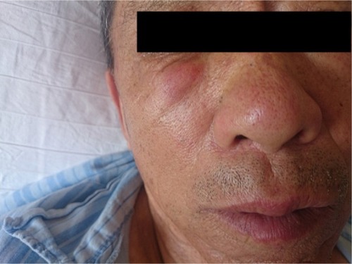 Figure 3 Preoperative facial photo of patient.