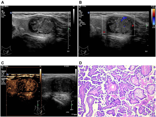 Figure 2 A 24mm papillary thyroid carcinoma with central cervical lymph node metastasis in a 37-year-old woman. (A) Gray-scale ultrasound shows a heterogeneous nodule in the left lobe of the thyroid, with a regular margin and microcalcification within the nodule. The adjacent thyroid capsule is continuous but protruded outward by the nodule. (B) Intranodular and peripheral blood flow signal is found on color Doppler imaging. (C) On contrast-enhanced ultrasound, comparing with the normal thyroid parenchyma, the tumor shows inhomogeneous hypo-enhancement, with partially clear enhanced border and incomplete ring enhancement. The adjacent thyroid capsule is discontinuous, which indicates an extrathyroidal extension. (D) Papillary thyroid carcinoma was confirmed by pathology (hematoxylin-eosin stain, ×200 magnification).