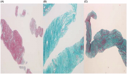 Figure 2. Pathological images of different types of uterine fibroids. (A) The content of smooth muscle cell was rich and the collagen fibers showed a thin, scattered distribution. (B) The content of smooth muscle cell was rare and the collagen fibers were thick, densely arranged and showed a bunched distribution. (C) The content of smooth muscle cell was lower, and the collagen fibers were of different thicknesses and were densely arranged.