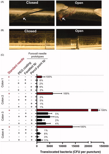 Figure 3. Standard Tru-Cut needle and prototype needle after puncture through an ex vivo human colon. (A) Representative images of the gap between the inner and outer needle parts of a standard 18 G Tru-Cut needle (Bard 18 G) when closed and partially open, following puncture of an ex-vivo human colon. White arrows indicate areas of visible fecal matter and tissue collection. Red line in the ‘open’ image indicates the position of the outer needle when closed, please note the extensive visual contamination. (B) Representative images of a 18 G Forsvall needle prototype (pencil tip with gold + PEG) following puncture with of an ex-vivo human colon, images show corresponding locations to images in A, closed and partially open. No foreign matter was visible at this magnification. (C) Mean number of colonies (CFU) translocated per puncture through each colon by the four Forsvall needle prototypes and the standard Tru-Cut needle. Percentages are indicated above each bar with the mean bacteria translocated by the standard needle set as 100% for each colon.