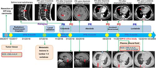 Figure 1 Timeline summarizing the therapeutic history for a non-small-cell lung cancer patient. MRI scans show lesions of the lumbar 1–3 vertebrae or brain (red arrows). CT imaging shows multiple right lung, pleural metastasis and massive right pleural effusion (red arrows).