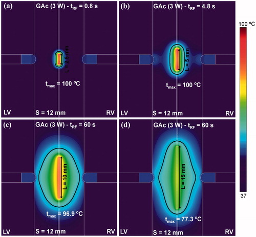 Figure 7. Effect of the length of the energised zone in the guidewire (ranging from 2.5 to 15 mm) on the temperature distribution in the tissue. Computer simulations were stopped when maximal temperature in the tissue reached 100 °C (tRF). Power of 4 W was applied between the energised zone and the irrigated-tip electrodes.