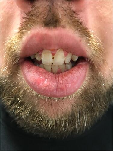 Figure 2 Marked lesional reduction and improved lip contour with absence of tissue friability was evident at 6 weeks post-treatment and maintained at 6 month follow-up.