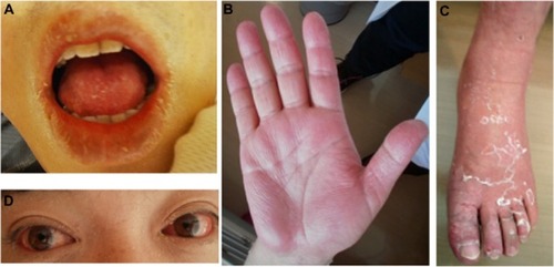 Figure 1 Desquamation around the (A) lips, (B) fingers, and (C) feet, and (D) bilateral non-exudative conjunctival injection.