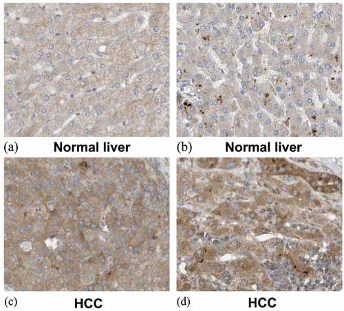 Figure 11. Expression of SYNJ2 in normal liver and HCC from the Human Protein Atlas database. (a, b) Low diffused staining of SYNJ2 in cytoplasmic and membranous of hepatocytes from samples 3402 and 2429. (c, d) Diffusedly brown medium staining of SYNJ2 in HCC tissues from patient 3196. The original images were magnified 400 times
