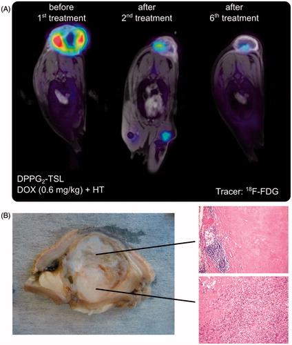 Figure 3. (A) # 10: PET/MRI fusion images demonstrating tumour response after two and after six treatments with DOX 0.6 mg/kg in DPPG2-TSL-DOX. (B) Macroscopic view and microscopic pictures (HE, ×50 magnification) of the subsequently resected tumour with complete necrosis and chronic inflammation (above) and residual malignant spindle cells (bottom). Complete tumour necrosis in the tumour part near to the applicator indicating insufficient heating in the basal part.