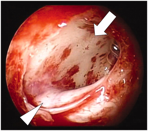 Figure 3. Intraoperative view of the cyst (arrow) and left optic nerve canal (arrowhead), both of which were opened endoscopically.