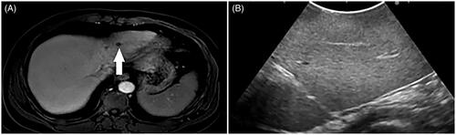 Figure 7. A 65-year-old male patient with CRLM. (A) MRI showed colorectal metastases in the liver at pre-surgical staging (thick arrow). (B) After preoperative chemotherapy, the tumor was not as clear as before chemotherapy during IOUS guidance.