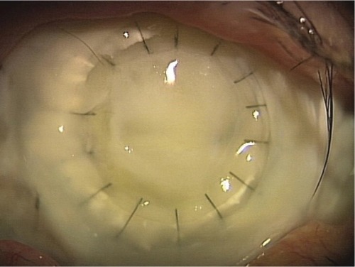 Figure 1 Case 4 (pre-injection). The corneal abscess caused by Aspergillus flavus has spread to most of the grafted cornea.