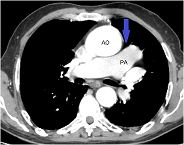 Figure 5 Axial CT scan image revealing lung tissue between the aorta and the main pulmonary artery (blue arrow).