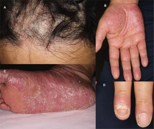 Figure 1 Psoriasiform skin lesions in the frontal scalp region (A), palms (B), soles (C), and fingernails (D).