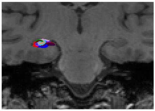 Figure 1 Representative subdivision of the hippocampal subfields. The mask of each region was overlapped on the coronal T1-weighted images. Color classification: parasubiculum = yellow; presubiculum = black; subiculum = blue; Cornu Ammonis (CA) 1 = red; CA3 = dark green; CA4 = brown; granule cell layer of dentate gyrus (GC-DG) = sky blue; hippocampus-amygdala-transition-area (HATA) = green; fimbria = purple; molecular layer hippocampus (HP) = dark brown; hippocampal fissure = dark purple; hippocampal tail = gray.