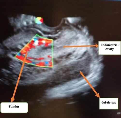 Figure 1 Ultrasound picture showing empty uterus with fundal vascularization.