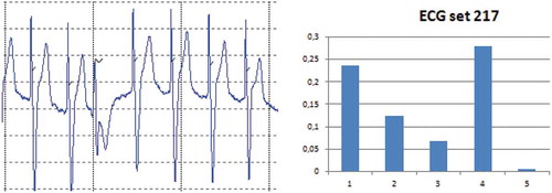 Figure 6. ECG set 217: A time/amplitude plot and the reduction in mutual information when one of the features (5) is left out.