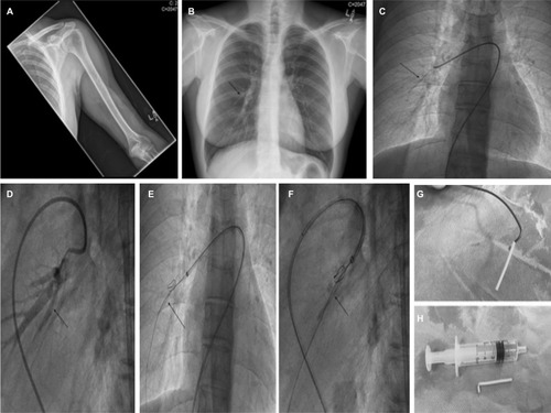 Figure 1 (A) AP radiograph (X-ray) of the left upper arm (humerus and cubital fossa) with no evidence of visible radiopaque subcutaneous contraceptive implant. (B) AP radiograph (X-ray) of the chest. This was initially reported as normal, but closer assessment of the right mid-zone shows the radiopaque contraceptive implant which was initially incorrectly interpreted as a prominent bronchovascular marking given its relatively short, linear outline (black arrow). On subsequent appreciation by the radiologists of the short, tubular shape of the Nexplanon® implant, the foreign body was immediately identified. (C) Judkins right (JR4) catheter positioned in the right pulmonary artery with the contraceptive implant visualized on fluoroscopy (black arrow). (D) Selective pulmonary angiography confirms the intravascular placement of the foreign body (black arrow) in a branch of the right lower lobe pulmonary artery. (E, F) AP and lateral fluoroscopy views demonstrating the utilization of a gooseneck snare to extract the foreign body from the pulmonary artery (black arrows). A straight-ended Terumo (Terumo Corporation, Tokyo, Japan) guidewire was utilized for support. (G, H) Explanted device attached to a Judkins diagnostic (JR4) catheter and the device adjacent to a 5 mL syringe to demonstrate size.