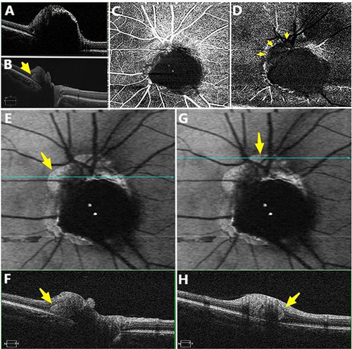 Figure 2 SD-OCT images of ODMC (A) and PHOMS (yellow arrow, (B). OCTA images showing superficial capillary plexus (C) and the blood flow signal of the deep capillary plexus was decreased in PHOMS (yellow arrow, (D). PHOMS showing peripapillary hyperreflective bright areas on en-face Min-IP image corresponding to B-scan OCT image (E, F, G and H, yellow arrow).