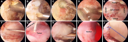 Figure 2 Intra-operative endoscopic images of UBE procedure. (A) Bleeding control and soft tissue detaching were performed with a bipolar radiofrequency instrument. (B) Intraoperative localization was performed using a 1.5mm Kirschner’s needle. (C and D) A high-speed diamond burr and Kerrison rongeurs were used to remove the lamina to expose the attachment of the ligamentum flavum. (E) The surgical field after removing the lamina and ligamentum flavum. (F) A scissor blade incised the dural sac. (G) The dissection of the tumor by a small blunt hook. (H) The IDEM tumor was piecemeal removed by a nucleus clamp. (I) Altogether removal of the tumor was achieved. (J) The dural sac was sutured under endoscopy.