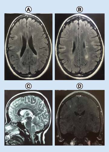 Figure 1. Axial FLAIR, sagittal T2W and coronal T1W+Gad brain MRI images.