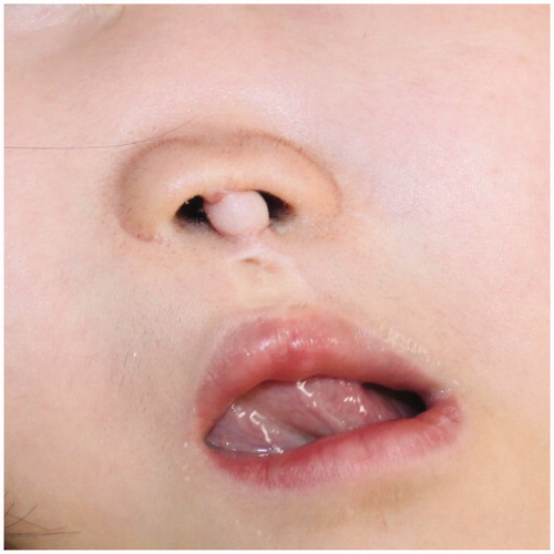 Figure 5. Defined cupid-bow of the lips, cupid peaks, and the columellar strut supporting the nasal dome after the eight-year follow-up period.