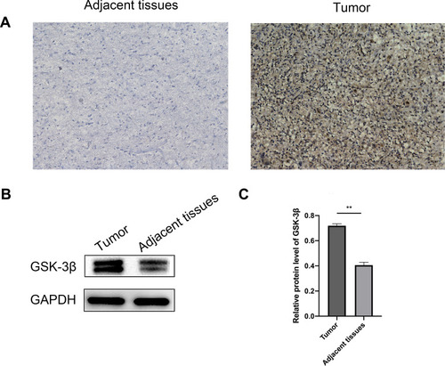 Figure 1 Expression of GSK-3β in pre-chordoma tissues. (A) The expressions of GSK-3β in adjacent and chordoma tissues were detected by immunohistochemistry analyses. Representative pictures show the expression of GSK-3β in chordoma tissues and adjacent tissues (100× magnification). (B) The expression of GSK-3β protein in chordoma and adjacent tissues was analyzed by Western blotting. (C) ImageJ software was used to analyze the results. Data are represented as the mean, **P < 0.01.