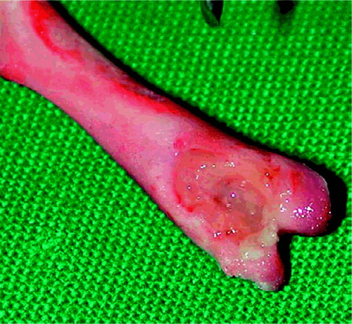 Figure 2. Osteomyelitis with marked bone destruction.