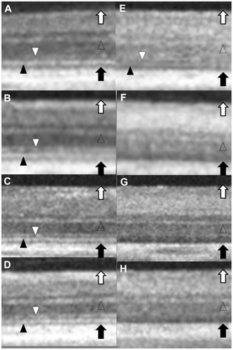 Figure 3 Optical coherence tomography (OCT) images of retina before (A–D) and after euthanasia (E–H corresponding to A–D, respectively). Figure 3A corresponds to Figure 2A and C. Figure 3D corresponds to Figure 2B and 2D. The internal limiting membrane line (white arrow), the outer plexiform layer (OPL) line (blank arrow head), the external limiting membrane (ELM) line (white arrow head), the inner and outer segments (IS/OS) (black arrow head), and the retinal pigment epithelium line (black arrow) on OCT images are observed in all four eyes prior to euthanasia (A–D). After euthanasia, the ELM (white arrow head) and the IS/OS (black arrow head) disappears in three of the four eyes (F–H) and, in one eye, the intensity of the ELM (white arrow head) and the IS/OS (black arrow head) is reduced (E). The OPL line (blank arrow head) is still observed in all four eyes (E–H).