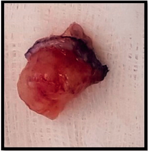 Figure 2. Intraoperative image of specimen excised from right distal fingertip.