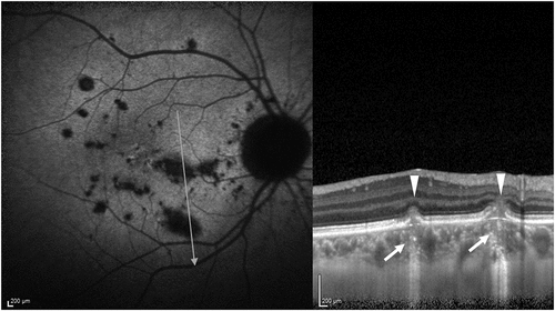 Figure 4. A patient with punctate inner choroidopathy (PIC). The autofluorescence image is shown in A. The lesions appear hypo-autofluorescent. The optical coherence tomography (OCT) line scan passing through two lesions of PIC shows the characteristic dome-shaped elevation of the retinal pigment epithelium and fuzziness of the outer retinal layers (white arrowheads). The choriocapillaris layer underneath the lesions has increased height and loss of the normal dotted pattern (white arrow), suggestive of choriocapillaris ischemia.