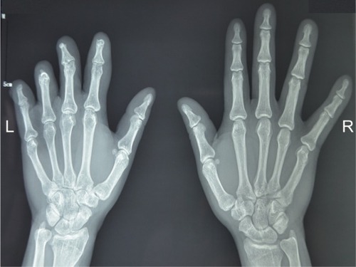 Figure 2 Male patient, 21 years old, with degloving damage involving four digits caused by machine-related trauma.