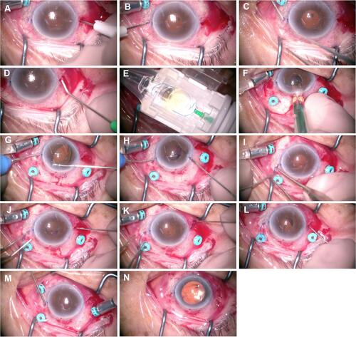 Figure 2 Modified intrascleral intraocular lens fixation surgery using a hook-shaped haptic intraocular lens. A scleral wound is created 180° and 1.5 mm away from the corneal limbus, using the knife attached to the 25G trocar (A and B). A scleral tunnel is created with the 23G knife (C and D). The intraocular lens is loaded into the cartridge (E) and inserted through the corneal incision (F). Two forceps are used (G and H) to grasp the trailing haptic and externalize it out of the eye (I). The other haptic is similarly grasped with the forceps (J) and externalized out of the eye (K). The hook-shaped part of the haptic is buried into the scleral tunnel (L and M). Following trocar removal, the wound closure is confirmed, and the surgery is completed (N).