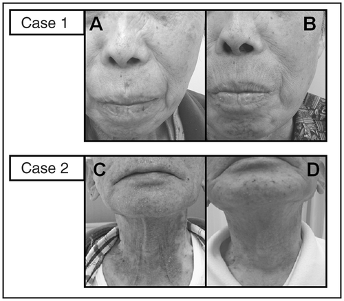 Figure 1. Case 1, (A) the skin lesions progressed to grade 2 with severe itching. (B) The skin lesions were ameliorated with improved itching after low-dose aspirin was started without dose reduction of erlotinib. Case 2, (C) After 1 week of treatment with erlotinib, a grade 2 skin rash developed with severe itching. (D) The skin lesions were ameliorate with improved itching after low-dose aspirin was started without dose reduction of erlotinib.