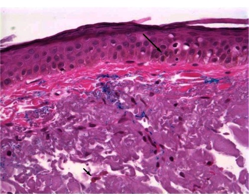 Figure 1 Minocycline-induced hyperpigmentation.