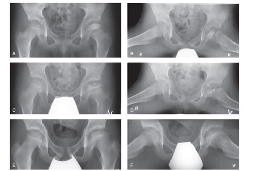 Radiographs of a boy with Perthes disease of the left hip.A and B. AP and lateral projections at diagnosis (age 8 years) of Perthes disease.C and D. Radiographs taken 8 months after diagnosis show fragmentation of the femoral head. The observers classified the radiographs with the following categories: Catterall group 3 (4 observers), Catterall group 2 (1 observer); original lateral pillar type B (4 observers), type C (1 observer); modified lateral pillar type B/C (3 observers), type B (2 observers).E and F. AP and frog-leg radiographs taken 4 years and 7 months after diagnosis, at an age of 13 years. Both projections show healing and were classified according to the modified Stulberg classification as follows: round femoral head (2 observers) and ovoid femoral head (2 observers). 2 observers reassessed the radiographs. These observers agreed upon round femoral head as “true” modified Stulberg classification.