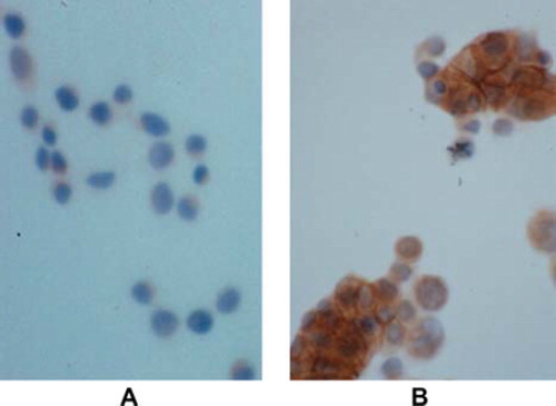 Figure 1. Induction of cell adhesion of E-cadherin transfectans. LS174T cell line lacks E-cadherin expression due to CDH1 gene mutation. These cells show poor differentiation and poor cohesive pattern of growth (A). E-cadherin transfection with mouse full length E-cadherin cDNA reverse LS174T cells to a non-transforming phenotype with cells being more cohesive and tightly connected with each other in monolayer (B); E-cadherin expression at intercellular adhesions is demonstrated in transfected cells by immunocytochemistry (brown immunostaining); A) and B) magnification × 20.