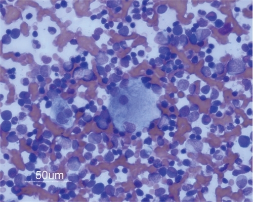 Figure 3 Pathological macrophages in bone marrow.
