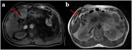 Figure 2. Intraoperative imaging: the microwave ablation needle showed low signal in all sequences and was inserted into the center of the tumor step by step (a,b). the scanning equipment was Ge MR750W with the following parameters: FOV = 40 cm, phase FOV = 0.8, and layer thickness 5.0 mm. Matrix = 256 * 192, NEX = 1, bandwidth = 142.8, flip angle = 15.