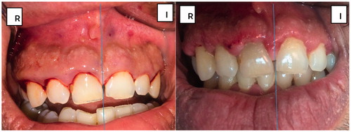 Figure 4. Clinical photographs taken preoperatively and after 1 week post-operatively.