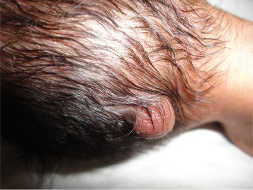 Figure 1 A photograph showing occipital encephalocele in the present case.
