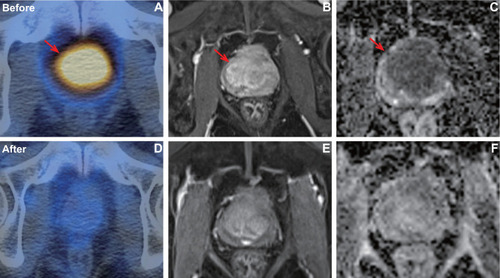 Figure 4 A patient with pathology confirmed prostate cancer of Gleason score 4+4 (T3bN0M0, very high risk) who showed good response after CIRT. PSMA uptake (A) was visualized on the prostate with TBR of 34.9. After CIRT, the SPECT/CT (D) showed PSMA uptake was significantly decreased with TBR of 3.4. Axial T1 weighted MRI showed the tumor before (B) and after (E) CIRT. In baseline ADC map (C), ADCmean was 0.616×10−3 mm2/s. In post CIRT ADC map (F), ADCmean was 1.205 × 10–3 mm2/s.