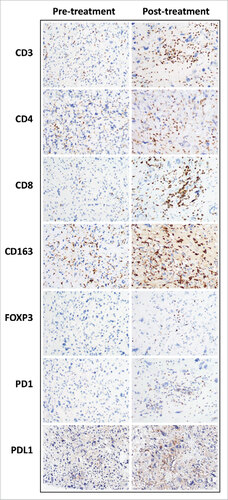 Figure 3. Comparison of immune infiltrate immunohistochemical studies in a pre- and post-treatment undifferentiated pleomorphic sarcoma. Representative photographs of immunostained undifferentiated pleomorphic sarcoma of the extremity and trunk. Increased CD3, CD4, CD8, CD163, FOXP3 and PD1 positive cells were seen in the post treatment specimen. Tumoral PD-L1 expression was increased.