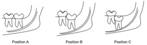 Figure 3 Pell-Gregory classification. Position (A) the apex of the crown is flat with, or above, the occlusal plane; position (B) the apex of the crown is below the occlusal plane but above the cervical margin of the second molar; position (C) the crown’s apex is below the cervical margin of the second molar.