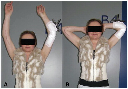 Figure 3. A and B. Postoperatively, with external fixator in place on the left side for guided and unloaded movement. Elbow extension was still restricted to 40 degrees on the left side at this time.