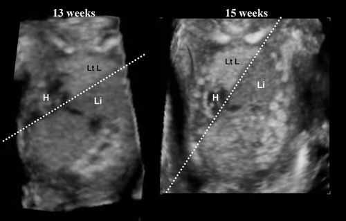 Figure 46.  Congenital diaphragmatic defect at 13 and 15 weeks of gestation. Referral case due to nuchal translucency of 3 mm at 11 weeks of gestation. (Left) frontal view at 13 weeks. Dextrocardia (H), liver-up (Li) and oppressed left lung (Lt L) are demonstrated. (Right) frontal view at 15 weeks. The line of Lung-liver border indicates acute angle changing in a short period due to progressive liver-up.